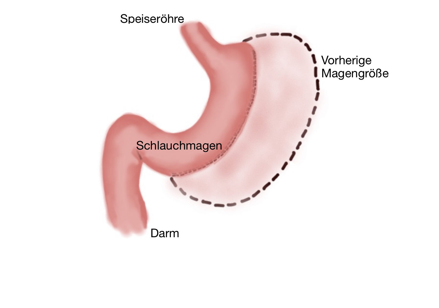 Magenverkleinerung Ernährung vor und nach einer Magenverkleinerung